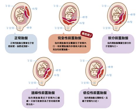 植入性胎盤